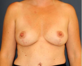 Feel Beautiful - Breast Lift 307 - After Photo